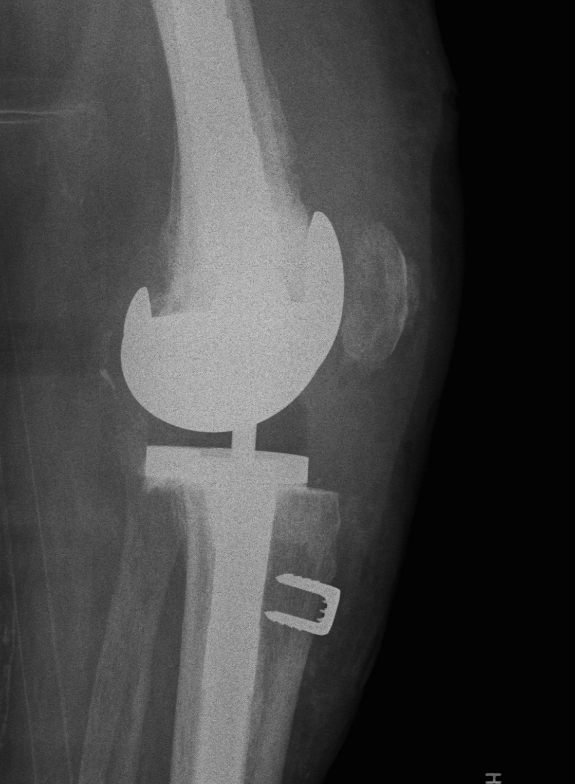 Revision TKR Staple Patella Tendon Insertion